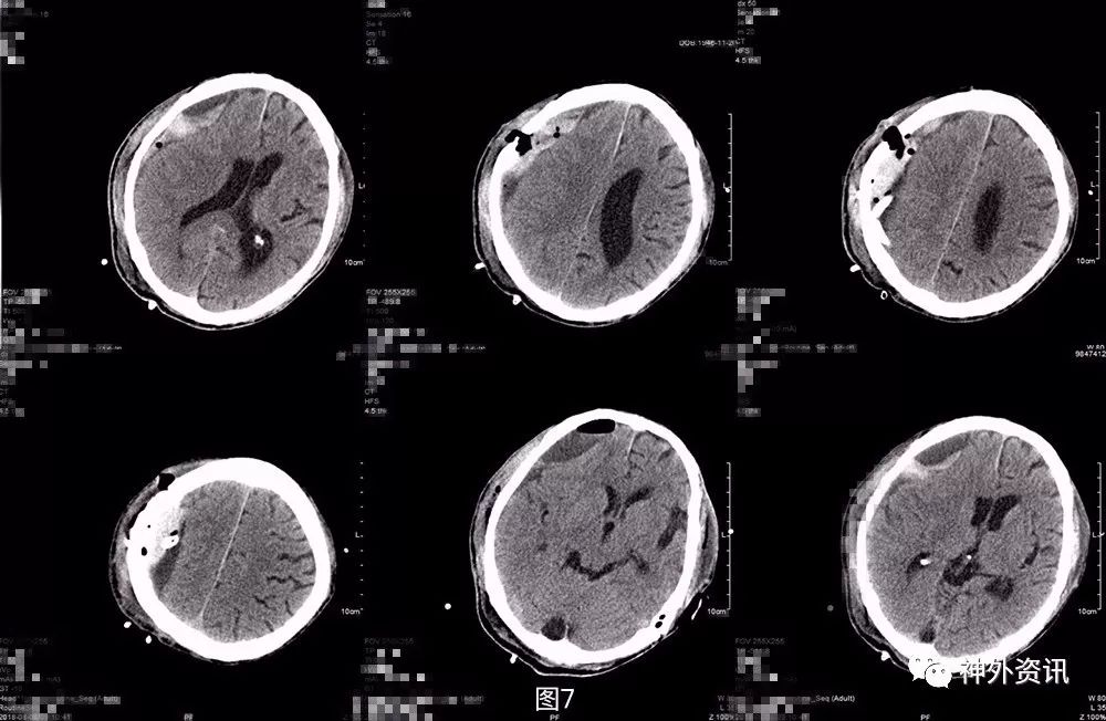 头颅血肿图片