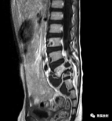 但无明显压缩变形,等t1,混杂稍长t2信号,stir呈高信号;邻近椎体及腰椎