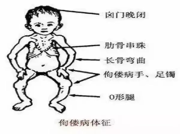 儿童缺钙鸡胸症状图片图片