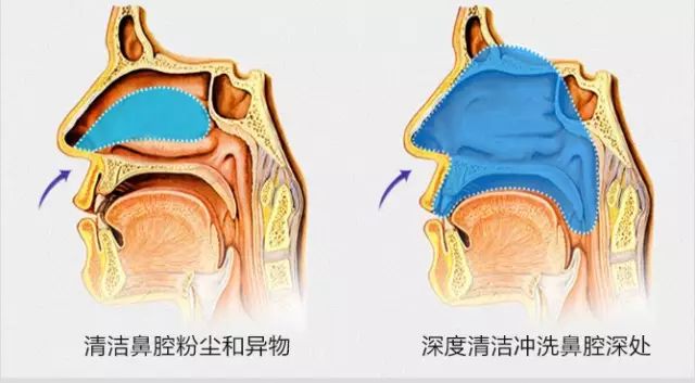 獨特防迴流設計 清洗效果看得見洗鼻液進入到鼻腔和鼻竇,清潔鼻腔後的