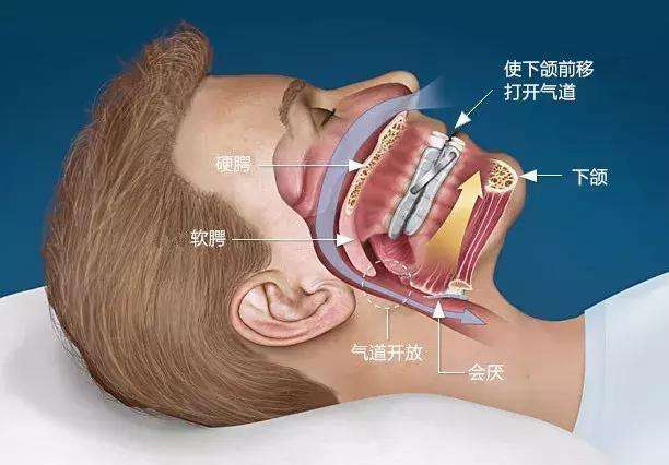 打鼾结构图片