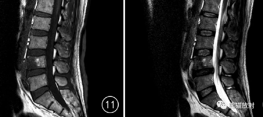 腰4單椎體結核,腰4椎體骨質破壞,但無明顯壓縮變形,等t1,混雜稍長t2