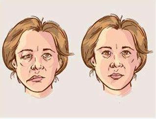 面肌痉挛早期症状图片图片