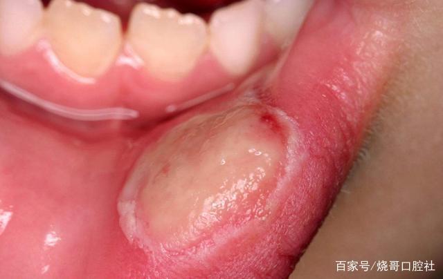 舌头长口腔溃疡该怎么治