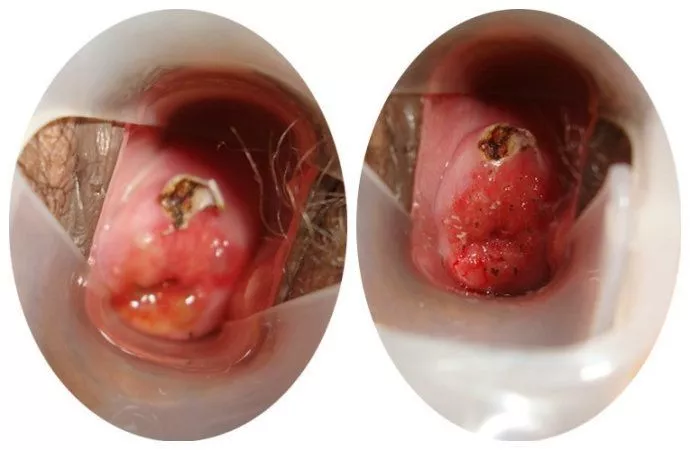 宫颈口长息肉的图片图片