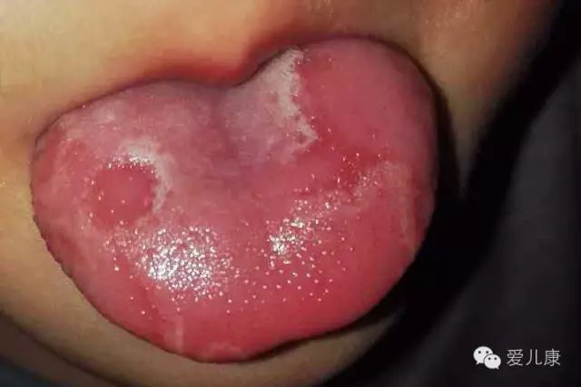 看一眼宝宝的舌头就知道哪里病了30秒教你读懂孩子体内的疾病信号