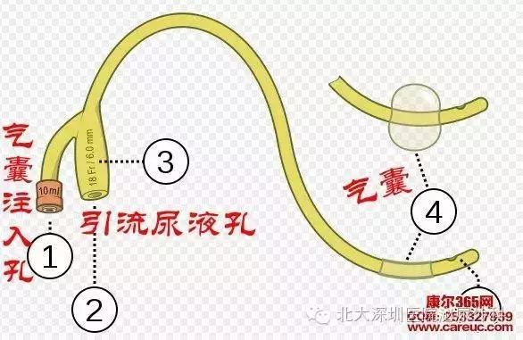拔气囊尿管步骤图解图片