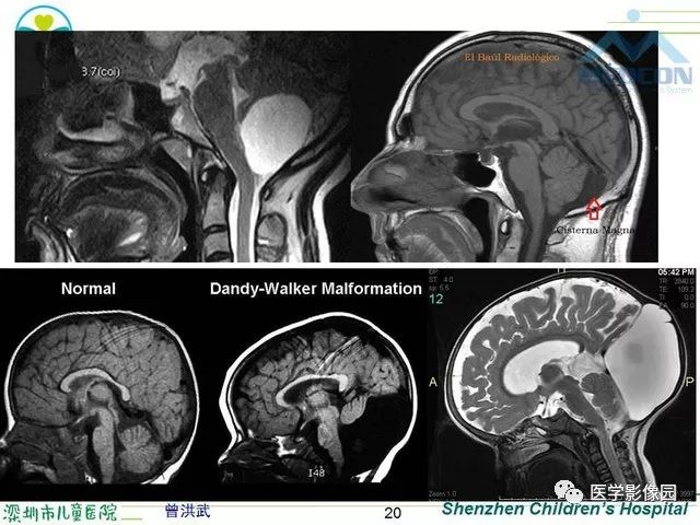 后颅窝先天畸型影像诊断影像天地