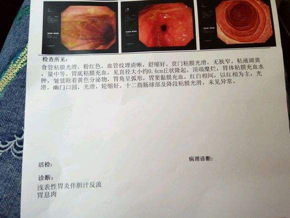 急性肠胃炎症状病情图片