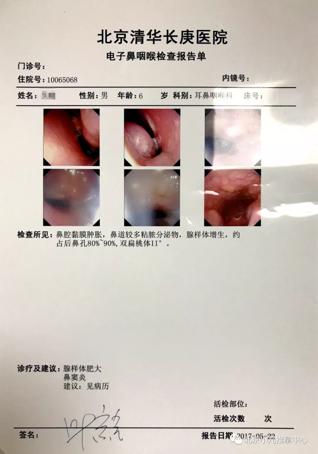 咱家寶寶腺樣體肥大是否手術切除?您考慮好了嗎?