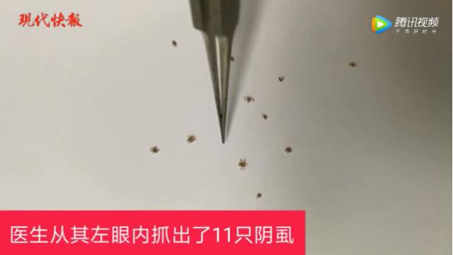 女童眼睫毛上附著11條蝨蟲22個蟲卵!孩子的這些家長要注意_陰蝨