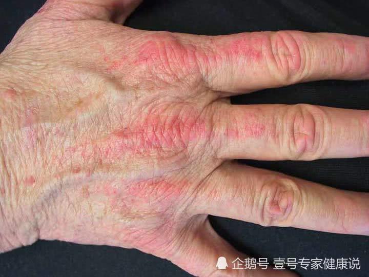 肺癌早期皮肤症状图片图片