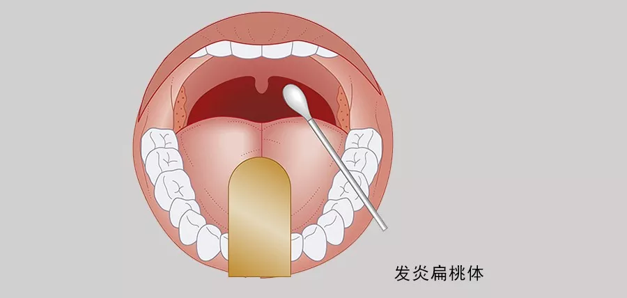 秋季扁桃体炎症高发季拿什么拯救你我的扁桃体