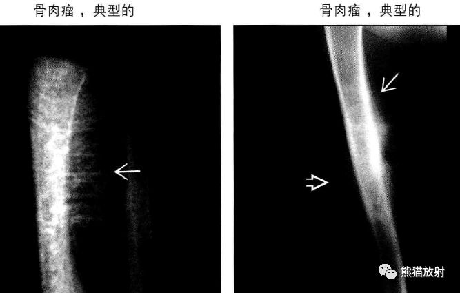 骨膜反应图片图片