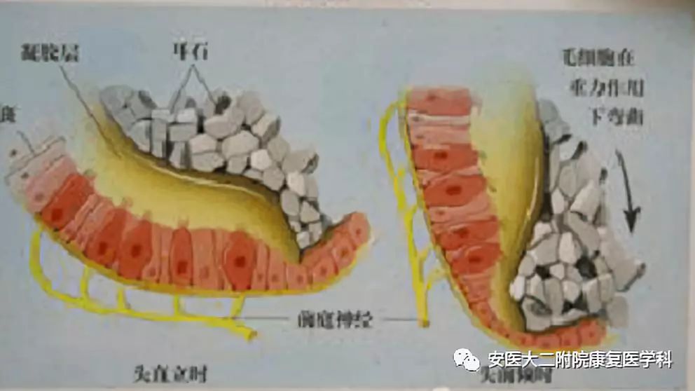 耳石脱落示意图图片