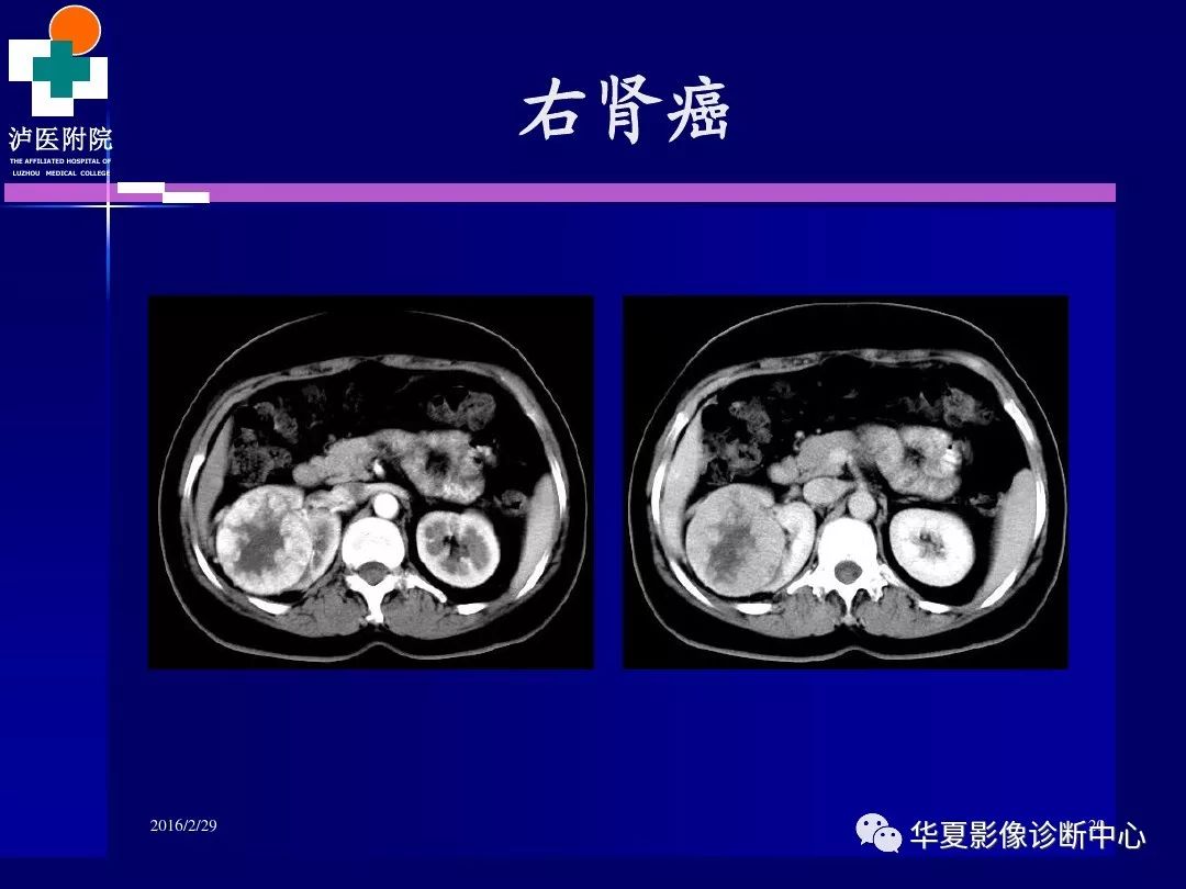 肾脏病变ct诊断全面经典解析