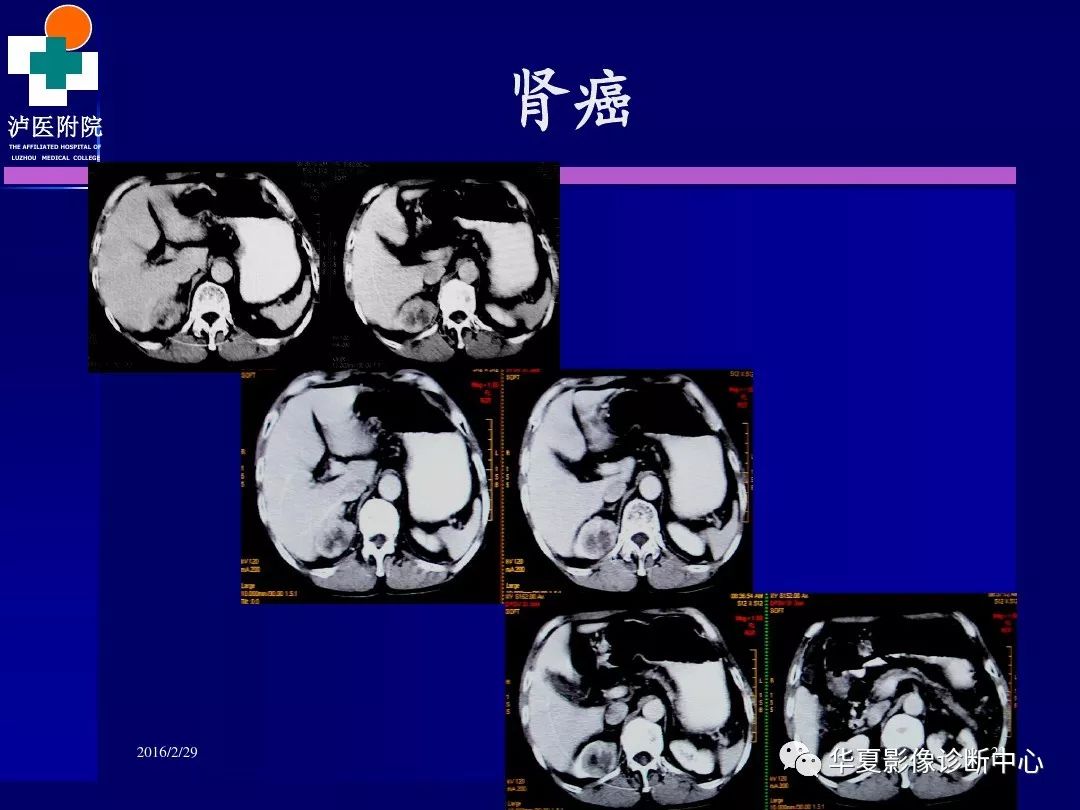 腎臟病變ct診斷全面經典解析