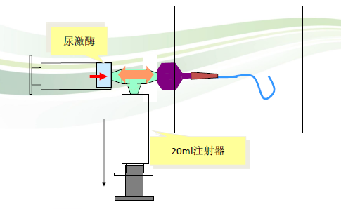 2,藉助三通一端空注射器抽吸picc導管內的液體,使導管內形成負壓後