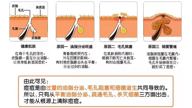 痘痘反复生长，那是痘根在作怪！_青春