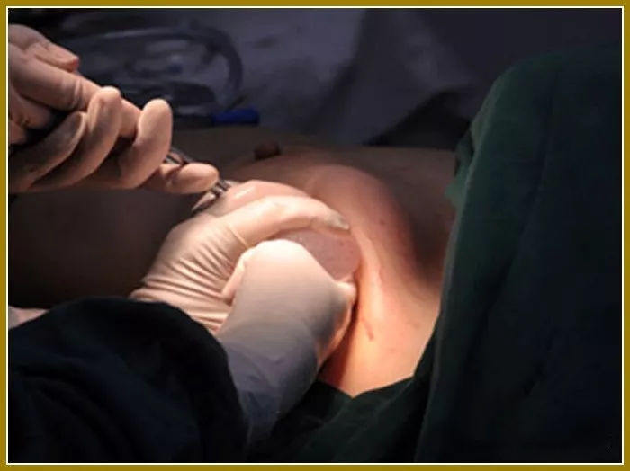 女性乳房手术图片