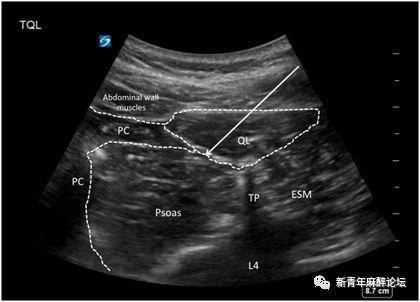 腰方肌超声图片