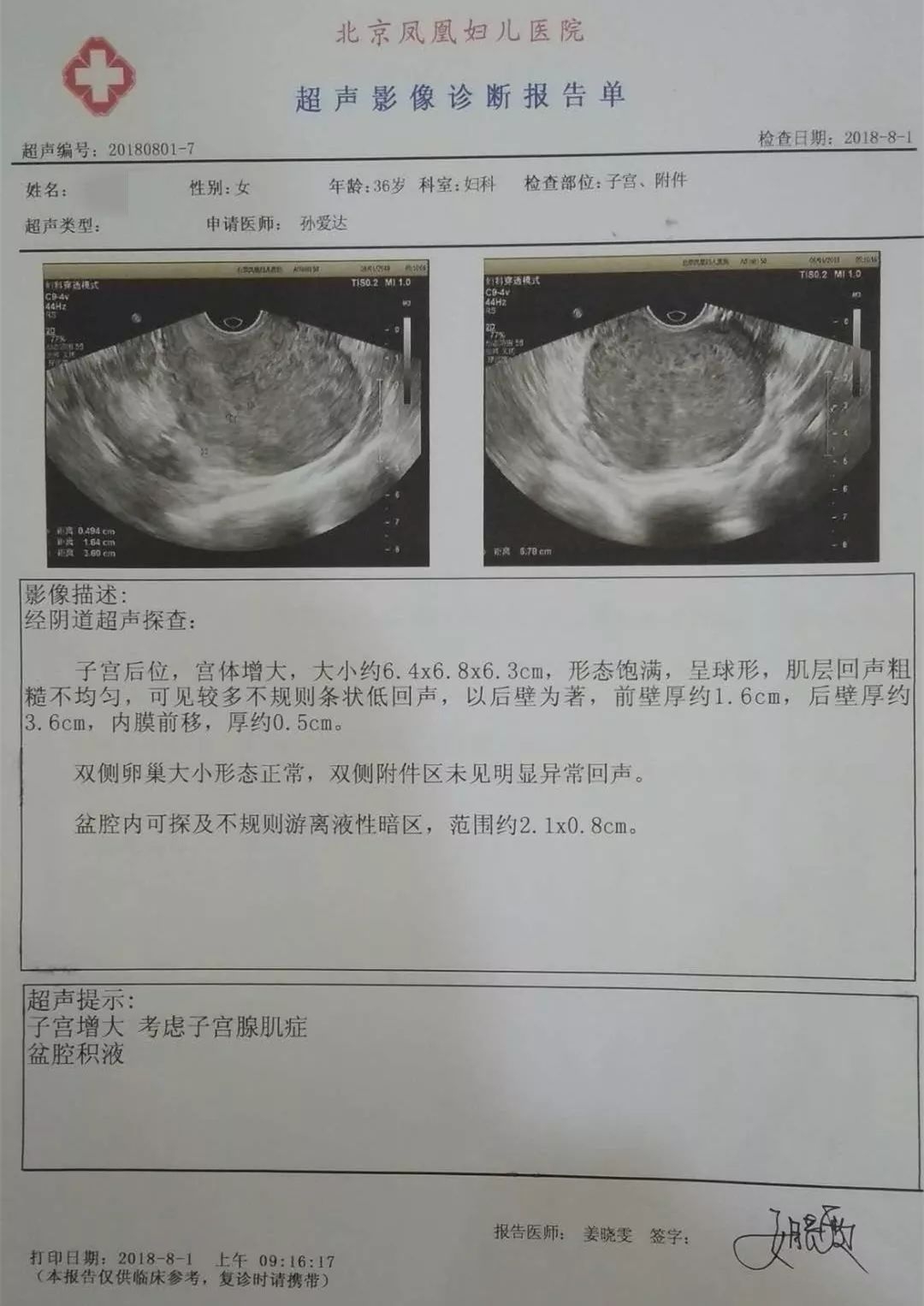 被腺肌症折磨的14年讓她生不如死