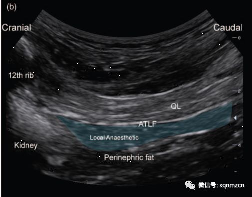 腰方肌超声图片