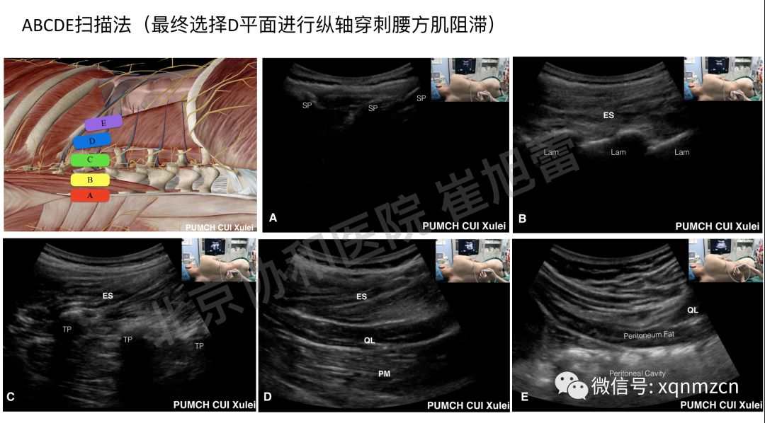 腰方肌超声图片