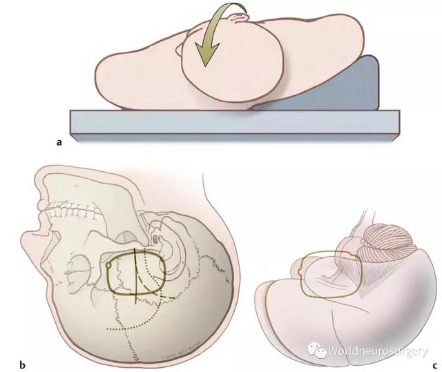 颅中窝入路spetzler教授脑干手术入路