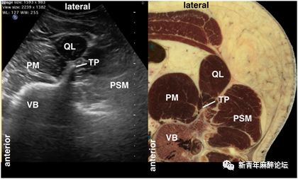 腰方肌超声图片