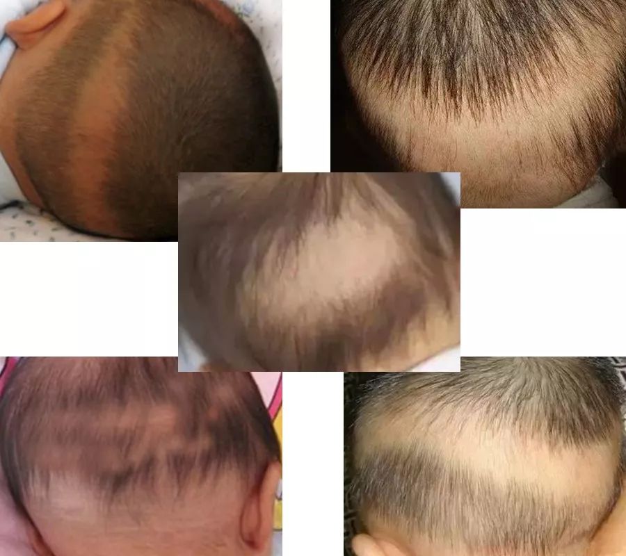 枕秃,是指孩子头部出现局部头发稀少或秃发的现象
