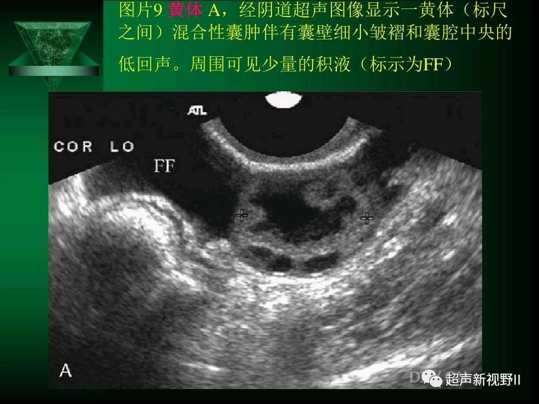 【超声微课堂】阴道超声检查规范