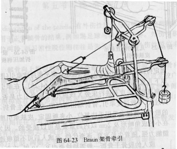 braun架牵引图片