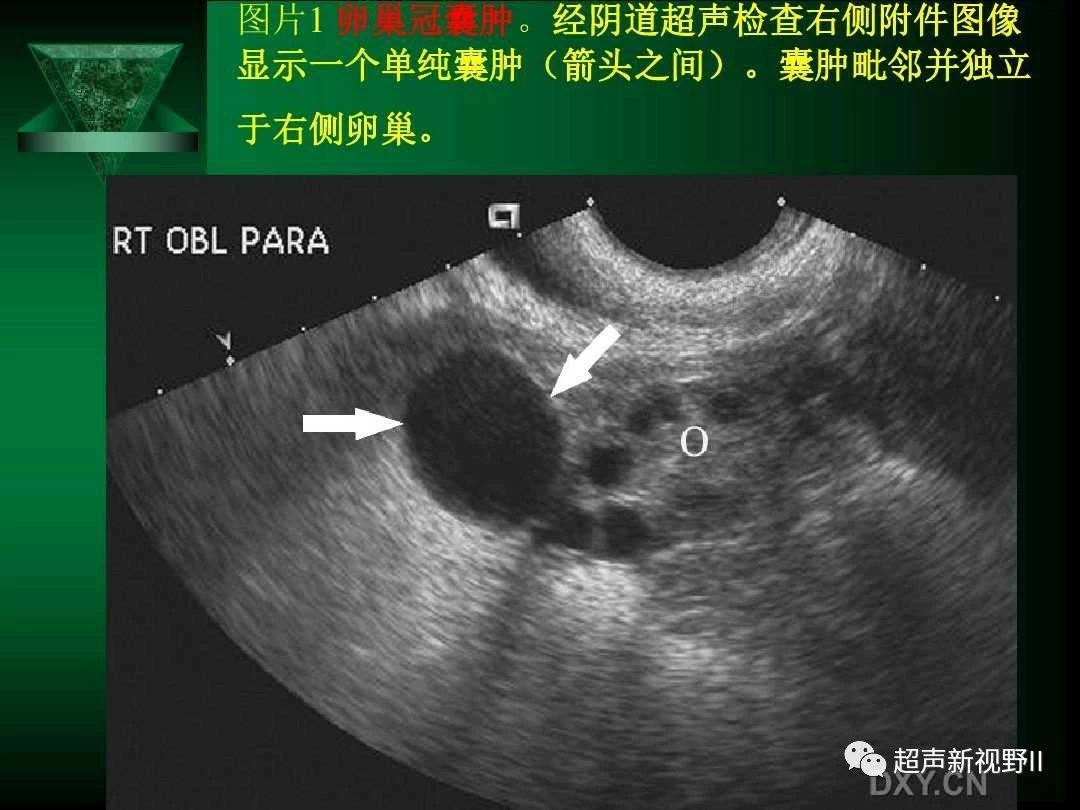 超聲微課堂陰道超聲檢查規範