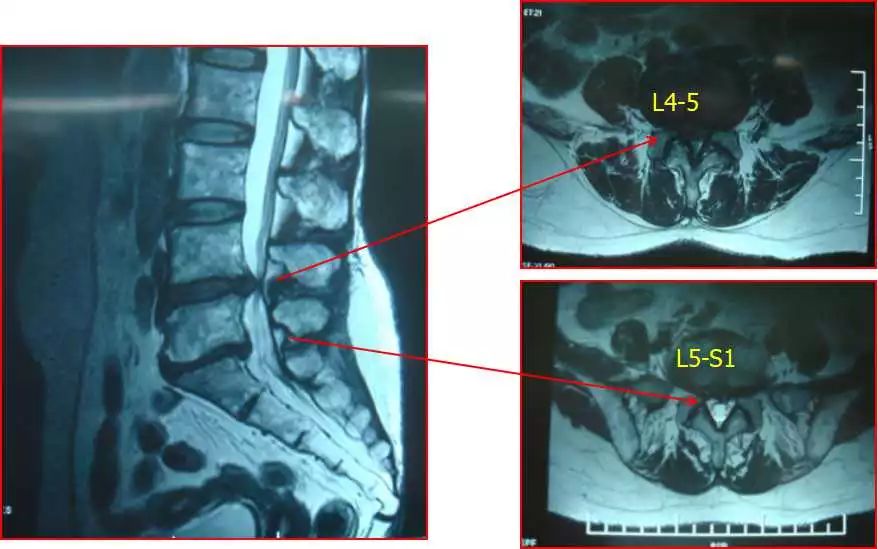 mri平扫图片示明显的腰椎间盘突出(图片来自上海中山医院)