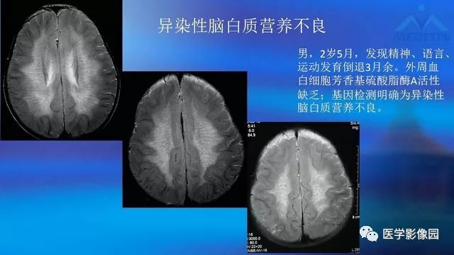 脑白质病变的影像表现与鉴别诊断影像天地