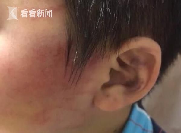 7歲男童學小提琴 卻遭老師多次毆打臉被扇腫