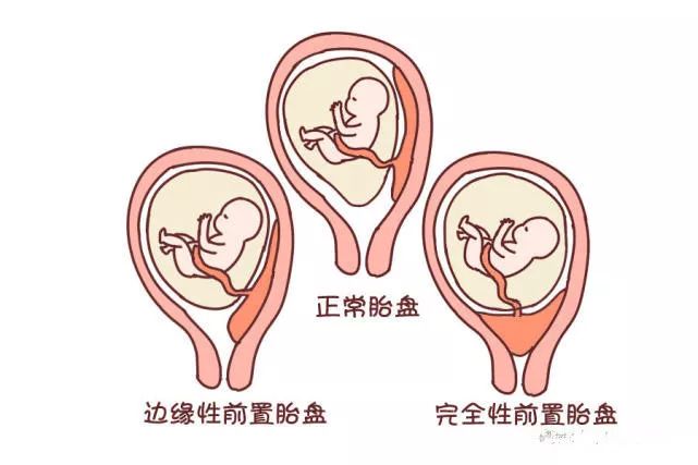 正常的胎盘位置图片