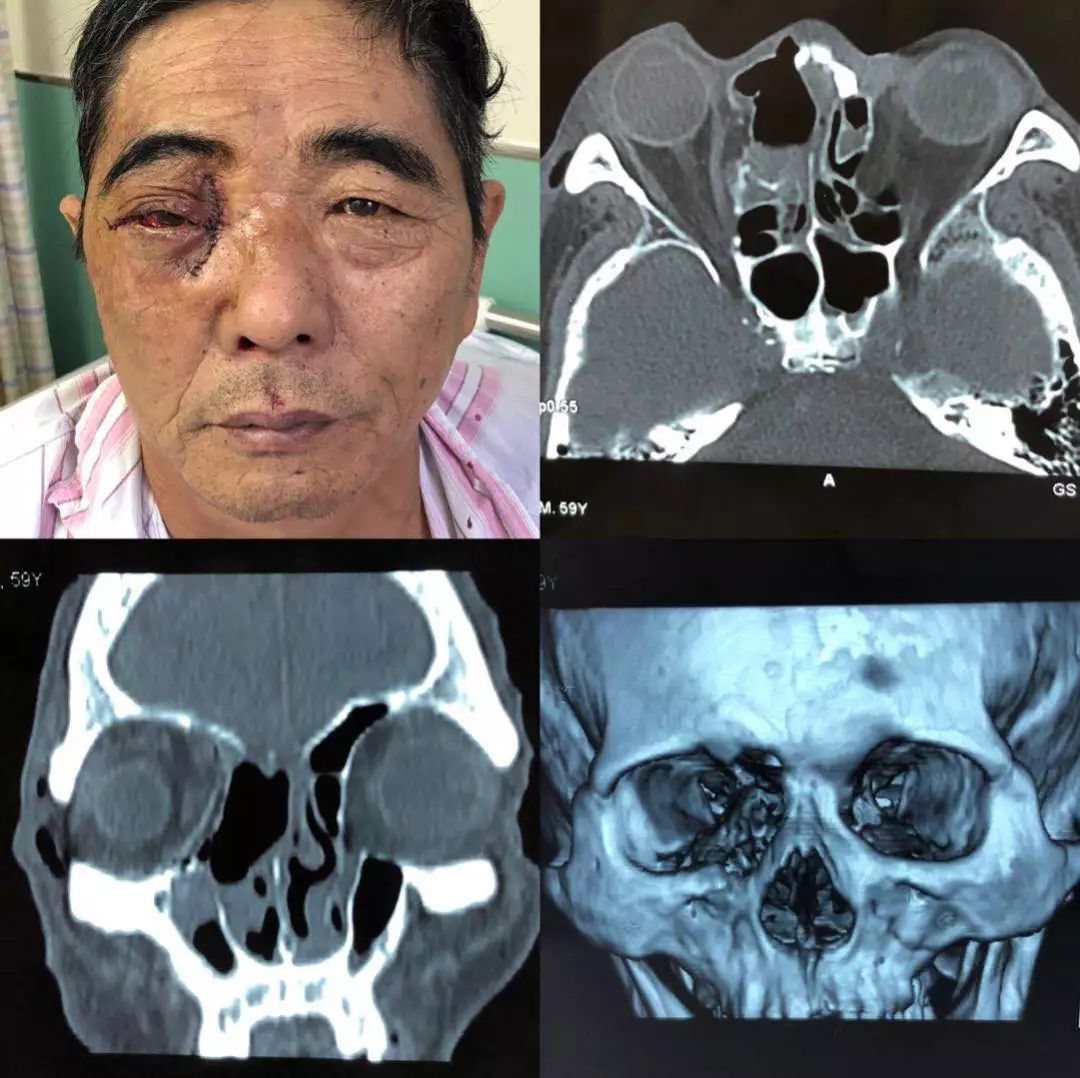 【病例分享】泪囊肿瘤累及鼻眶筛术后功能性修复