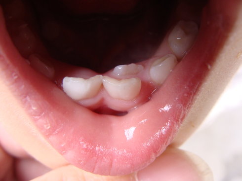 6岁小孩门牙松了给牙医拔掉,2个月都没长出新牙正常吗?