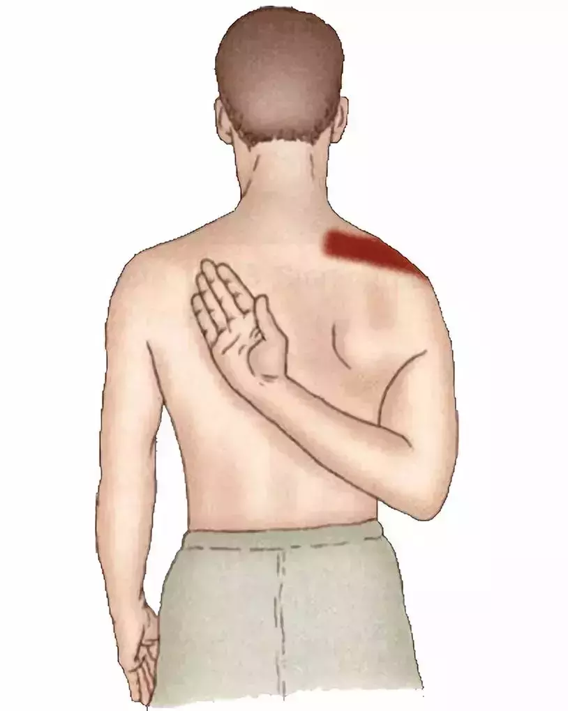 【康知了】冈上肌——肩周炎首要肌肉,肩痛的前因后果