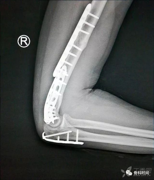 本病例的肱骨干骨折,你会选择髓内针还是钢板?欢迎在评论区参与讨论