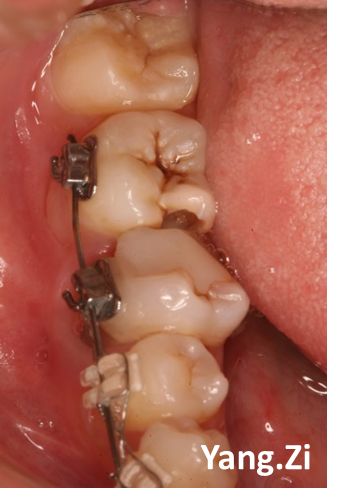 下颌第二磨牙c3型弯曲根管一例
