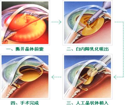 白内障手术示意图图片