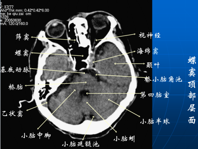 头颅CT解剖图图片