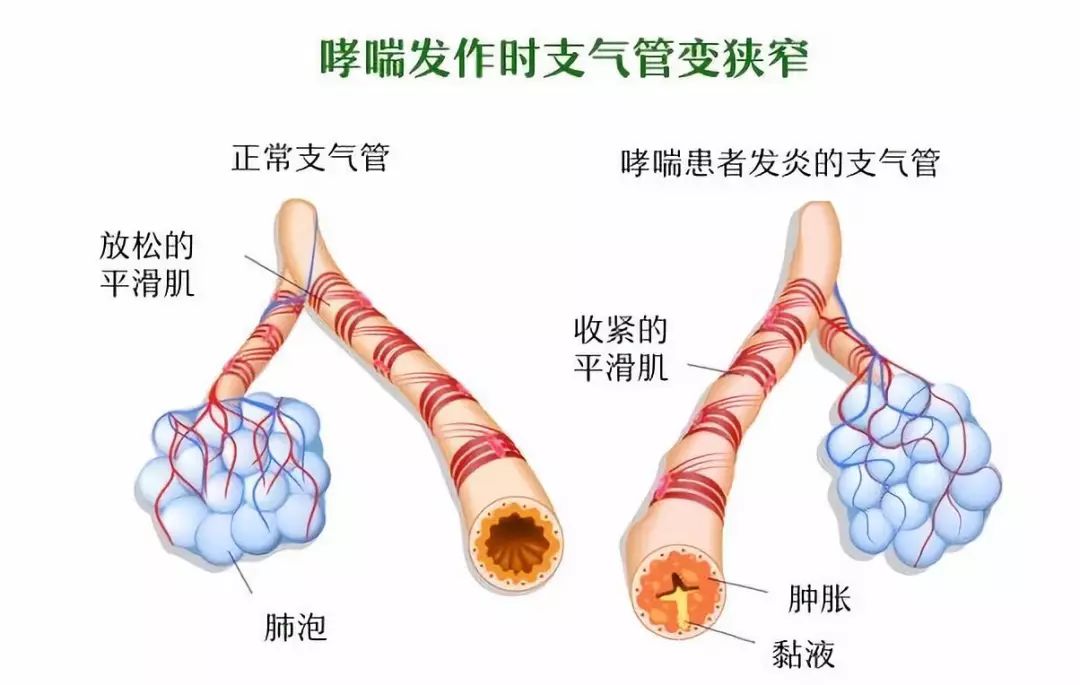 支气管炎的位置图片图片