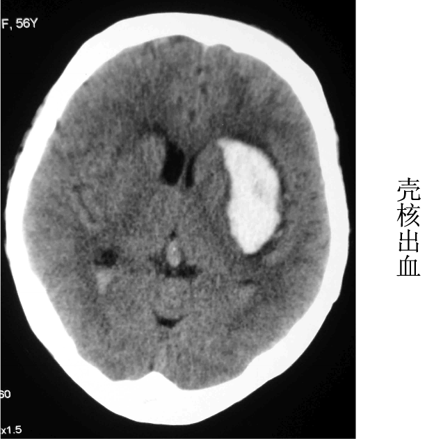 壳核出血图片