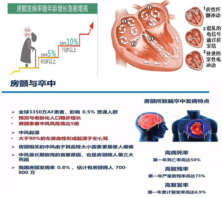 健康科普 警惕突发脑卒中的帮凶—房颤