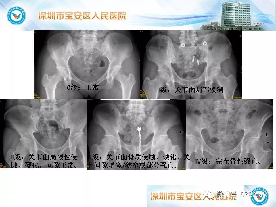 骶髂關節非腫瘤性病變影像診斷