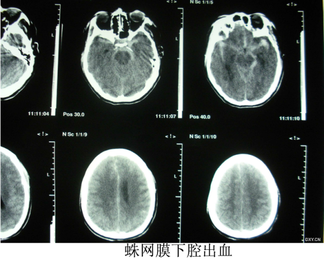 頭顱ct解剖與常見出血梗死判讀